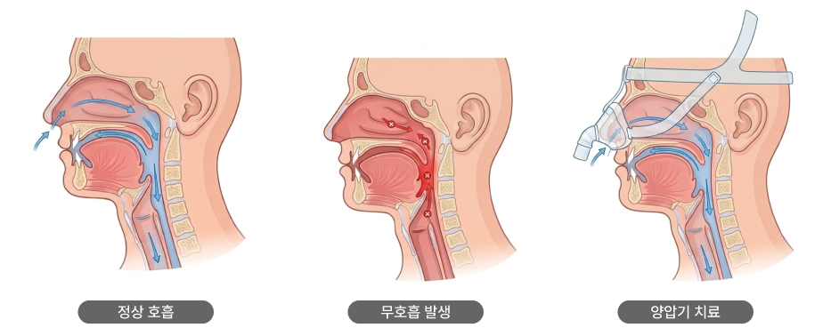 양압기 치료