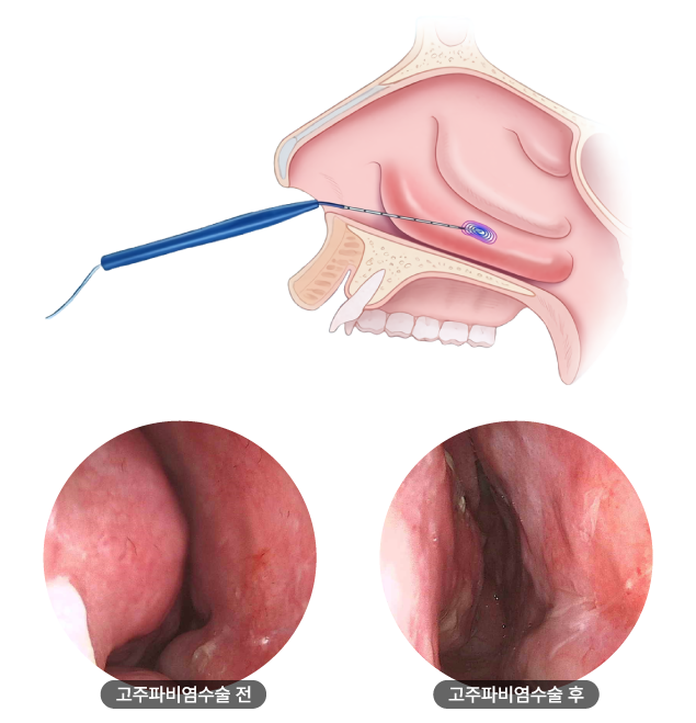 고주파비염수술 설명 1